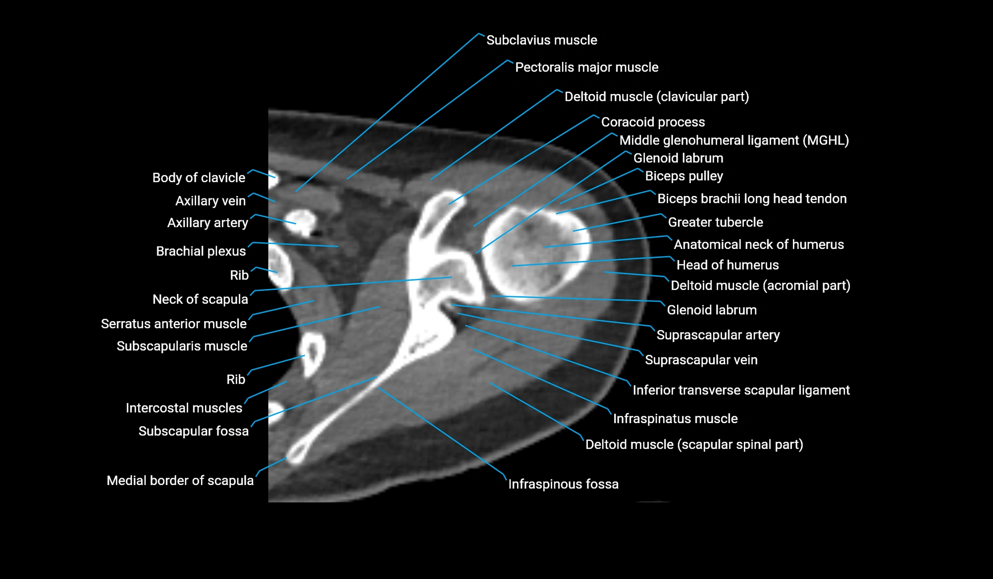 CT upper arm axial  cross sectional anatomy labelled radiology image -00084.webp